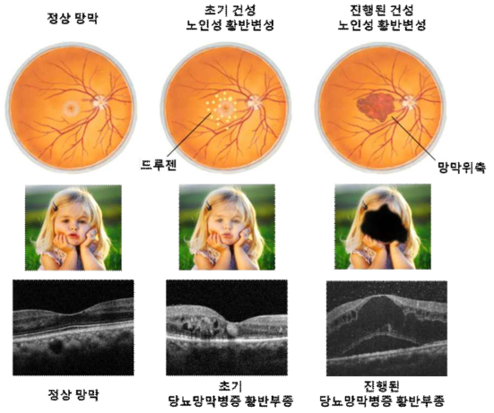 난치·만성 망막질환의 진행