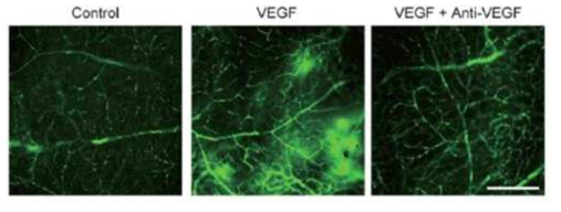 당뇨망막병증 황반부종 관련 유효인자인 VEGF 조절을 통한 혈관 투과성 억제