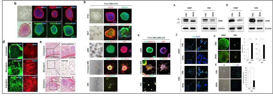 SMA 환자유래 운동신경 세포주 확립 및 질병 표현형 확인