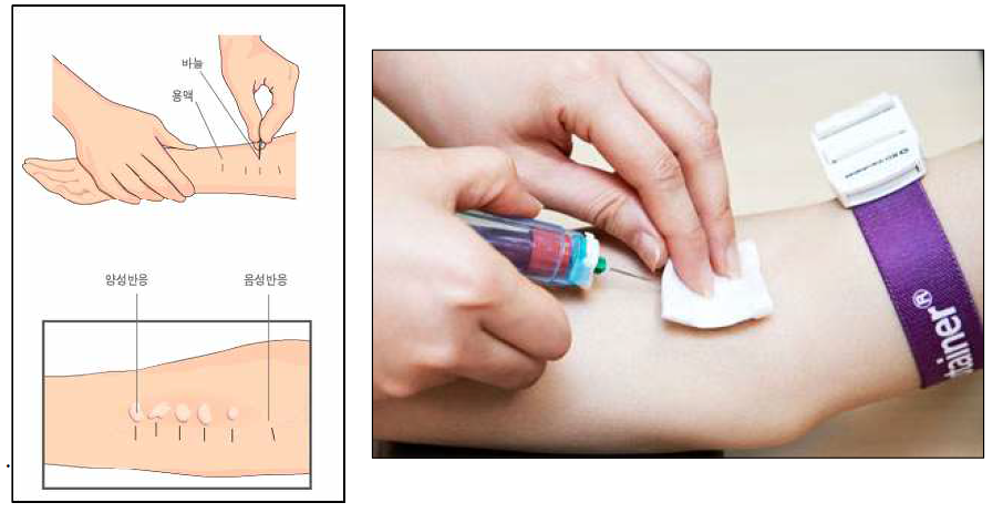 알레르기 비염 진단을 위한 침습적 검사인 피부 단자 검사, 혈액 검사