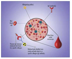 알레르기 비염환자의 혈액을 통해 총 Ig E, 특이 Ig E,혈액내 호산구 등을 통해 진단할 수 있음