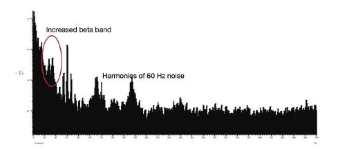 LFP from microelectrode show increased beta activity