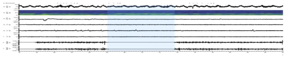 increased beta activity of subthalamic nucleus during movement tasks (off-movement)