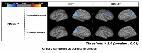 volumetric changes of precuneus in Parkinson’s disease patients with lower urinary tract symptoms