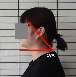 두부척추각도(craniovertebral angle,CVA) * 측정 방법 : 측면에서 7번 목뼈의 가시돌기를 지나는 수평선 귀의 귀구슬과 7번 목뼈의 가시돌기를 잇는 선이 이루는 각도를 측정