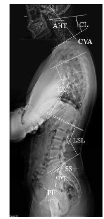 Measurement methods for head and spino-pelvic parameters AHT; Anterior head translation distance, CVA; Craniovertebral angle, CL; Cervical lordosis, TK; Thoracic kyphosis, LSL; Lumbosacral lordosis, SS; Sacral slope, PT; Pelvic tilt, PI; Pelvic incidence * 측정방법: 양팔을 끌어안은 자세(cross-arm position)로 손을 가슴 앞에 교차하여 놓을 상태에서 정면을 보고, 두발을 어깨너비로 벌려 바로 선 자세에서 측면(lateral view) 전 척추 방사선 촬영(whole spine X-ray)을 하였다. 방사선 영상 분석 소프트웨어(Santa DICOM Viewer free, Santesoft Ltd, 사이프러스)를 이용