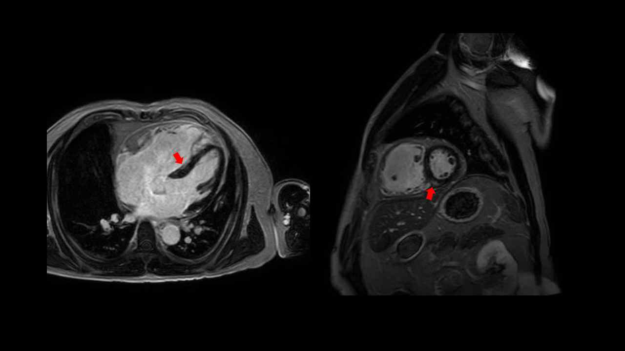 LGE at the right ventricle basal septum insertion point on CMR The arrow indicates fibrosis. CMR; cardiac magnetic resonance imaging, LGE; Late gadolinium enhancement