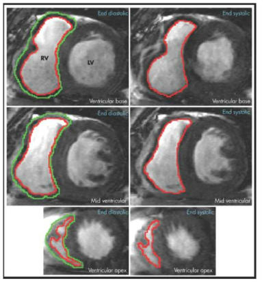 심장 자기 공명 영상을 이용하여 이완기 및 수축기 말 우심실 용적을 측정하여 전체적인 우심실 용적의 변화를 살펴볼 수 있음