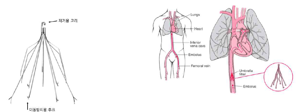 A. 제거 가능한 하대정맥 필터 B. 하대정맥 필터와 폐동맥색전과의 관계