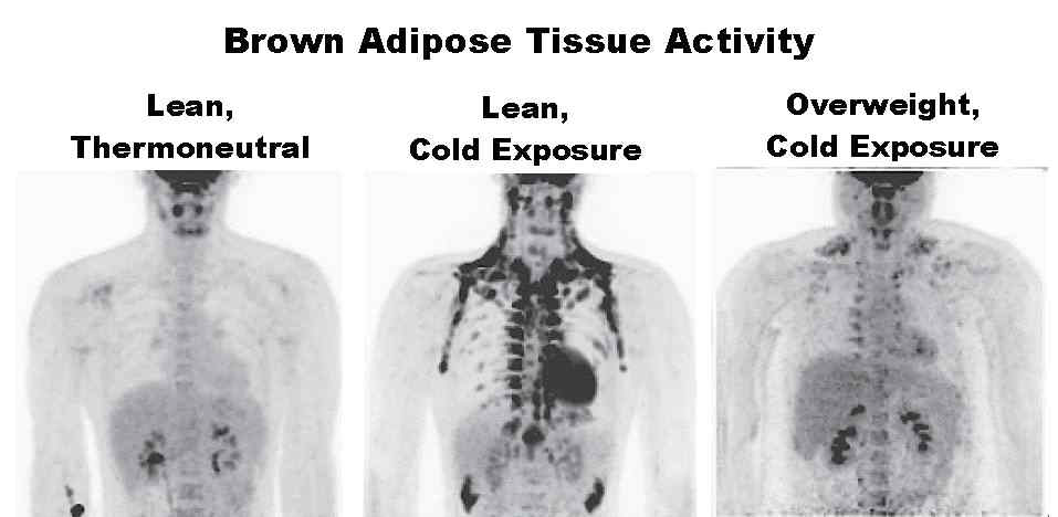 비만도에 따른 갈색지방화의 차이
