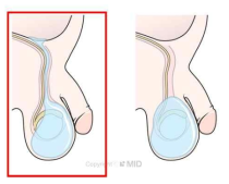 교통성 음낭수종; 거의 대부분의 소아형 음낭수종