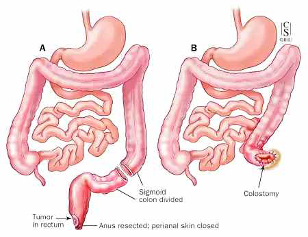 하부 직장암의 수술 직장을 포함하여 항문을 완전 제거 http://www.hopkinscoloncancercenter.org/