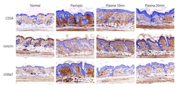 SKH-1 마우스에 SKH-1 aldara cream (5% imiquimod)으로 건선을 유도 한 후 플라즈마를 조사한 후 조직을 채취하여 고정한 후 면역조직화학법으로 CD34, lorecrin, s100a7의 발현을 확인