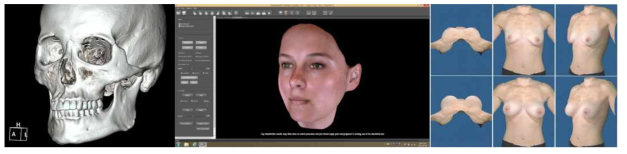3D CT(좌), 3D scanner로 scan된 환자의 얼굴(중)과 유방(우)