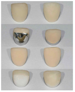 하부구조 디자인에 따른 금속-도재관 및 지르코니아-리튬디실리케이트 보철물
