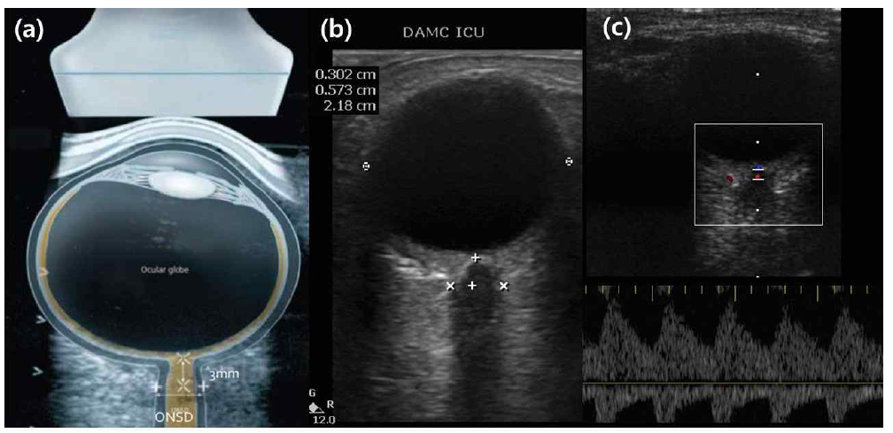 (a) 안구 초음파를 이용하여 ONSD 측정하는 그림 (b) 실제 초음파에서 ONSD를 측정한 사진 (c) ONSD를 측정하는 방법을 응용하여 망막 중심 동맥에서 혈류 속도를 측정한 사진
