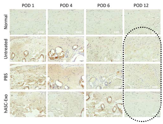 Immunohistochemistry – CD68 CD68은 Macrophage의 표면 항원으로 염증에 의한 Chemotaxis로 Macrophage가 화상 부위로 이동해온 정도를 파악할 수 있음. hASC-Exo 투여군이 타군에 비해 현저하게 적은 침윤을 보임