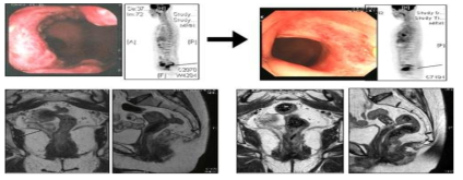 수술 전 항암방사선 치료 시행 전후의 내시경, 양전자단층촬영, 자기공명 사진