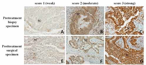 Immunohistochemical analysis of PD-L1expression in colorectal tissues.