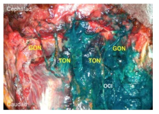 1ml (왼쪽) 과 5ml (오른쪽)을 사용한 대후두신경 차단의 주사제 확산 양상 비교. 축약어: GON, greater occipital nerve; TON, third occipital nerve; OCI, obliquus capitis inferior
