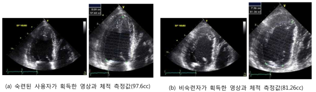 사용자에 따라 다르게 측정된 2차원 심장 초음파 영상에서의 좌심실 체적값