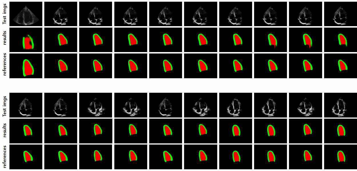 U-net 구조를 적용한 좌심실 영역 분할 결과