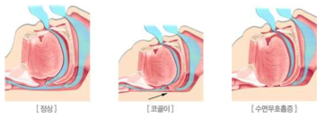 코골이와 수면무호흡 (출처: http://www.ulsanhana.com/nose_02.html)