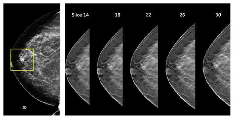 기존에 사용되고 있는 일반 맘모그램(Mammogram) 영상과 2.5차원 영상이라고 할 수 있는 디지털 영상합성법(Tomosynthesis) 영상의 비교. 더 많은 볼륨에 대한 정보를 바탕으로 정확한 유방암의 진단을 가능하게 함