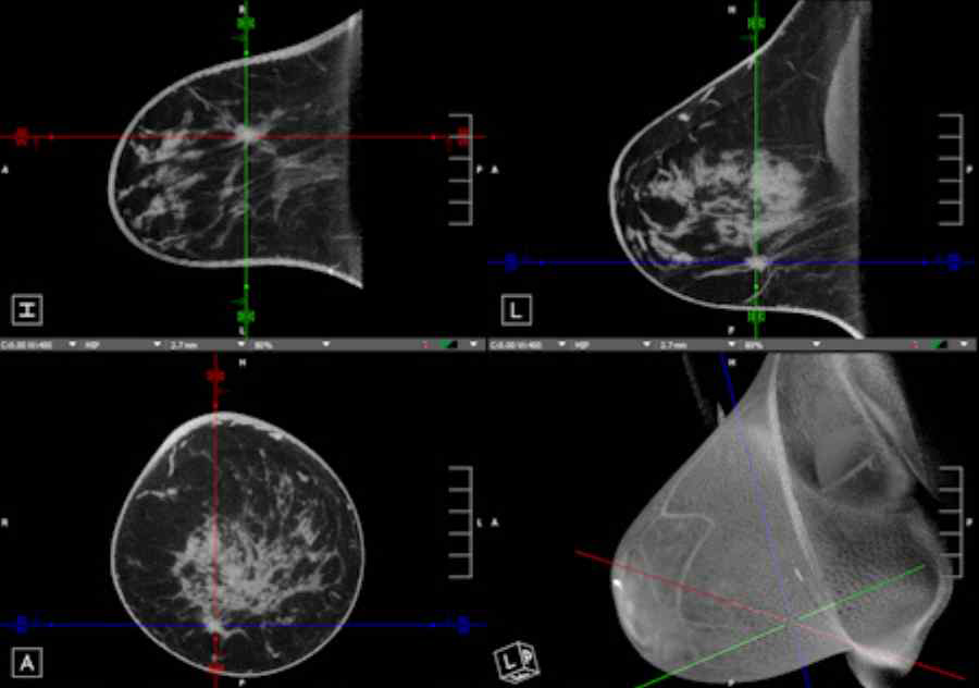 최근 기술이 개발되고 있는 유방전용 CT(BCT)의 영상. 완벽한 3차원 볼륨에 대한 정밀하고 풍부한 정보를 활용하여 보다 정확하고 진단율이 높은 진단이 가능함. 기존의 단순한 영상재구성 기술이 아닌 초고속, 저선량 및 분자영상 등의 차세대 BCT 영상 재구성 기술 필요 http://www.auntminnie.com