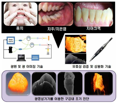 구강내 구조/기능 진단을 광영상 기기 기술의 개념도