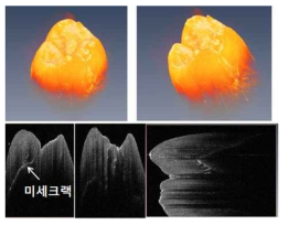 치아(어금니)의 광학단층영상