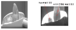 백색광 하에서의 resin 도포 치아 및 우식 치아 이미지(좌), 근적외선(853 ㎚) LED 광원에 대한 resin 도포 치아 및 우식 치아 이미지(우)