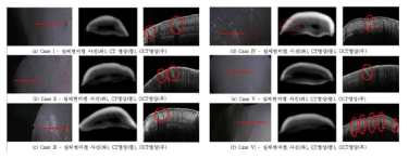 치아 파절 케이스별 실체현미경(좌),CBCT(중), 광단층영상(우) 비교
