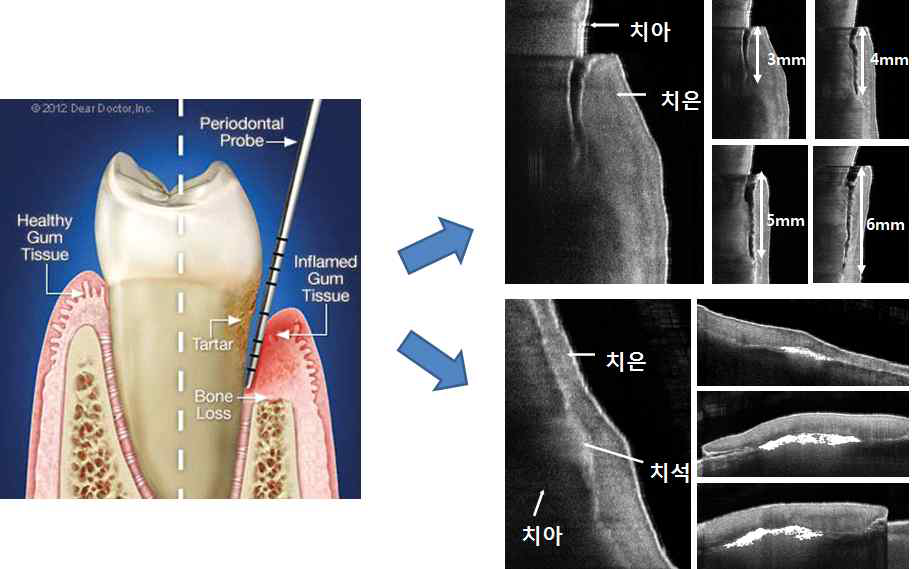 치주질환의 진단을 위한 기존 방법과 광단층영상(치은열구, 치은연하치석) 비교