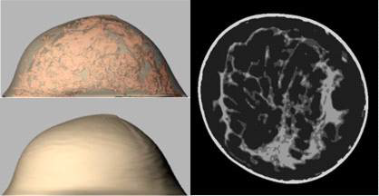 CT 데이터를 이용해 제작된 유방 팬텀: 매우 사실적인 형상을 얻을 수 있으나 해상도에 대한 제한에 따라 본 연구에서는 난수기반 팬텀 제작