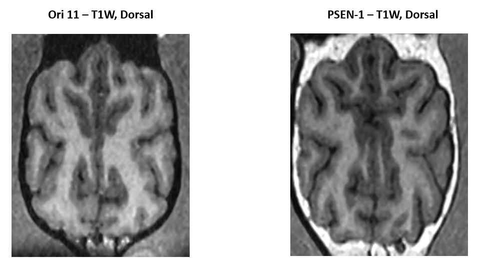 No remarkable cortical atrophy is observed in the T1-weighted dorsal plane images