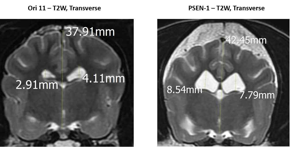 In the T2-weighted transverse images, Moderate ventriculomegaly is observed in PSEN-1 dog (Brain height/lateral ventricle height = Rt. 0.20, Lt. 0.18) No signs of ventriculomegaly is observed in Ori-11 (Brain height/lateral ventricle height = Rt. 0.08, Lt. 0.11)