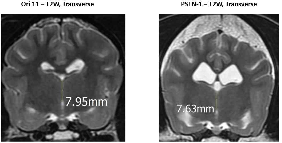 No difference is observed in terms of interthalamic adhesion length (Ori 11: 7.95 mm, PSEN-1: 7.63 mm)