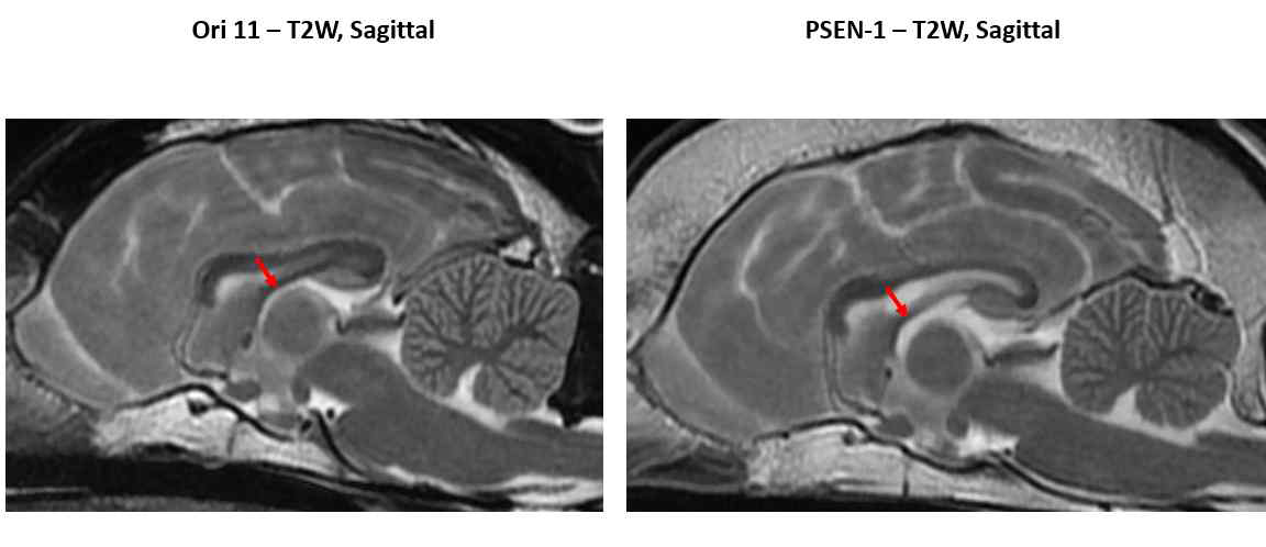 In T2-weighted sagittal image planes, No difference is observed in terms of interthalamic adhesion morphology (arrows)