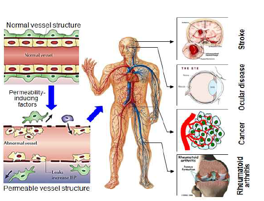 혈관투과성과 난치성 혈관질환