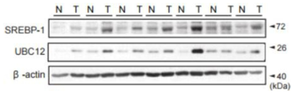 SREBP-1과 UBC12 발현 차이 확인에 대한 환자 시료 분석