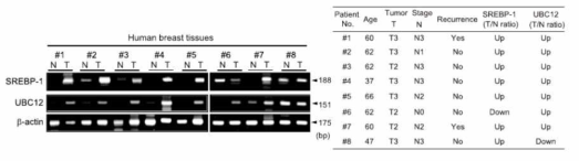 유방암 환자 조직에서 SREBP-1과 UBC12의 유전자 발현 분석 N, 정상 유방조직; T, 유방암 조직