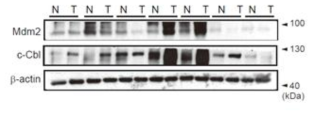 간암 환자 조직에서 Mdm2와 c-Cbl 발현 관찰