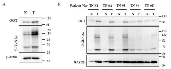 종양유도마우스모델 및 TNBC환자의 정상유방조직과 유방암조직 내 O-GlcNAc 수식화 비교