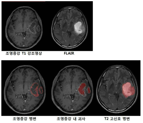 뇌 종양 분할의 예. 조영증강 병변, 조영증강 내 괴사, T2 고신호 병변을 구분하여 분할