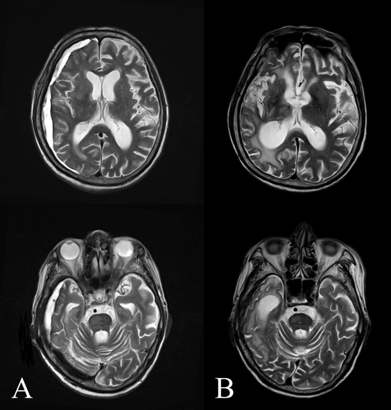 경막하 출혈 이후 시간경과에 따른 뇌 MRI 의 변화
