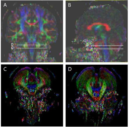 대뇌피질 척수로의 선정위치3) A: Coronal color FA map; B: Sagittal color FA map; C: The seed ROI of CST at the pontomedullary junction; D: The seed ROI of CST at the mid-pons