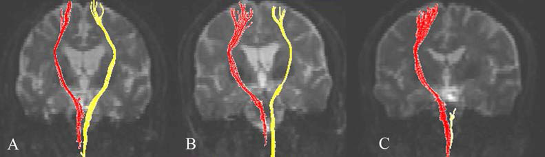 대뇌피질 척수로와 수부기능의 회복 반영 그림