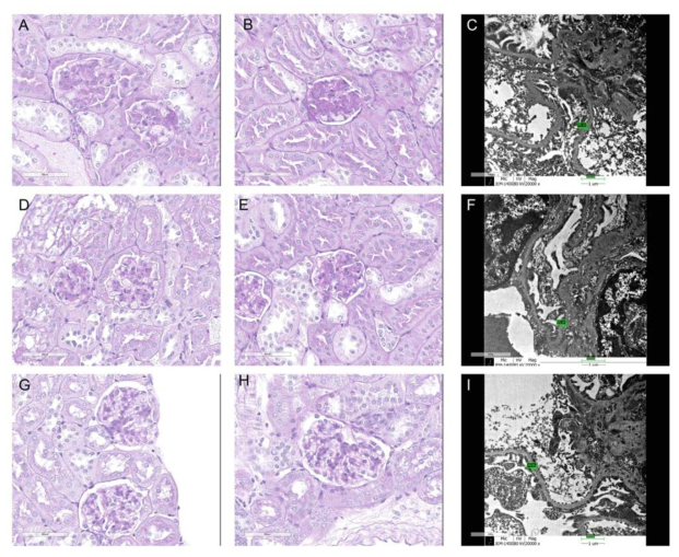 db/db mouse renal cortex PAS 염색 소견과 전자현미경 소견 (A, B,C): 대조군, (D,E,F)： empagliflozin 치료군, (G,H,I) : Liraglutide 치료군