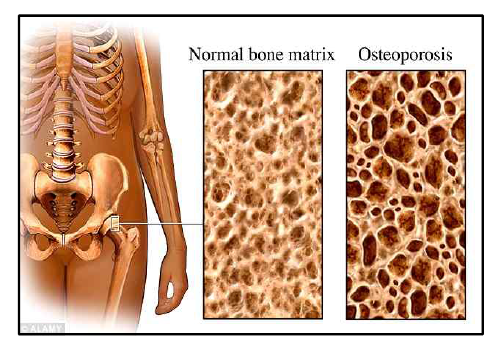 골다공증 환자의 골 밀도 변화